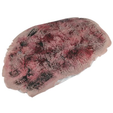 Plaie brûlure grave sur filet