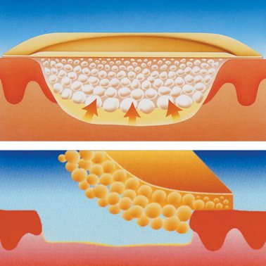 Pansements hydrocolloïdes emballés Hydrocoll