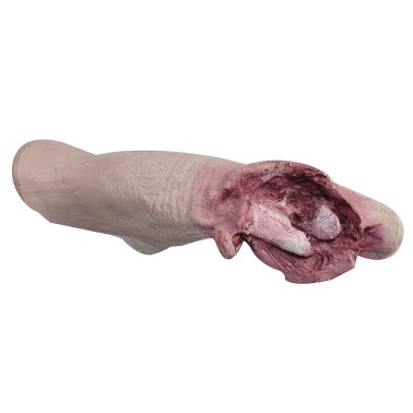 Doigt écrasé sur filet