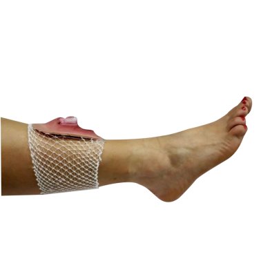 Fracture ouverte du tibia sur filet