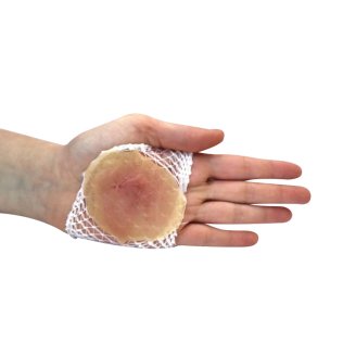 Plaie brûlure simple sur filet