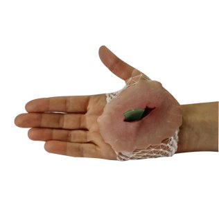 Plaie tesson de bouteille sur filet