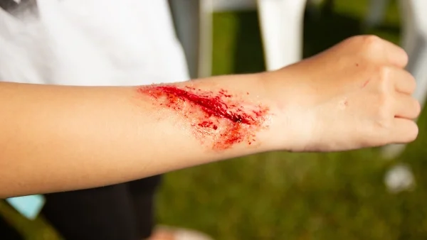 Guide comment désinfecter une plaie